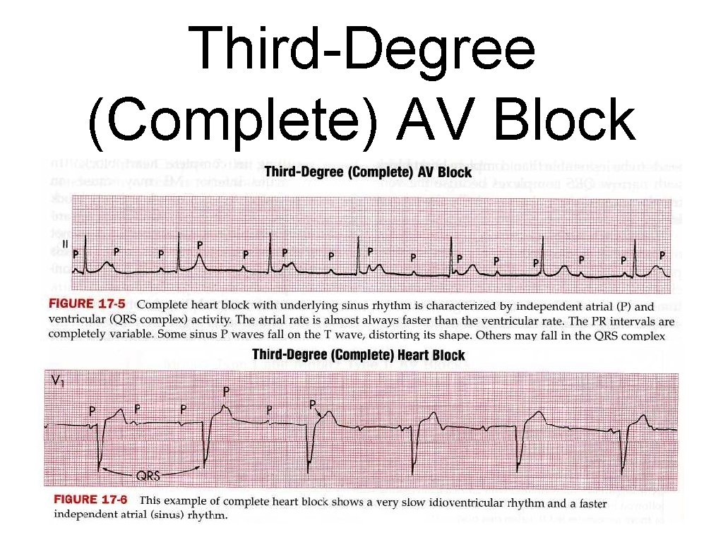 Third-Degree (Complete) AV Block 