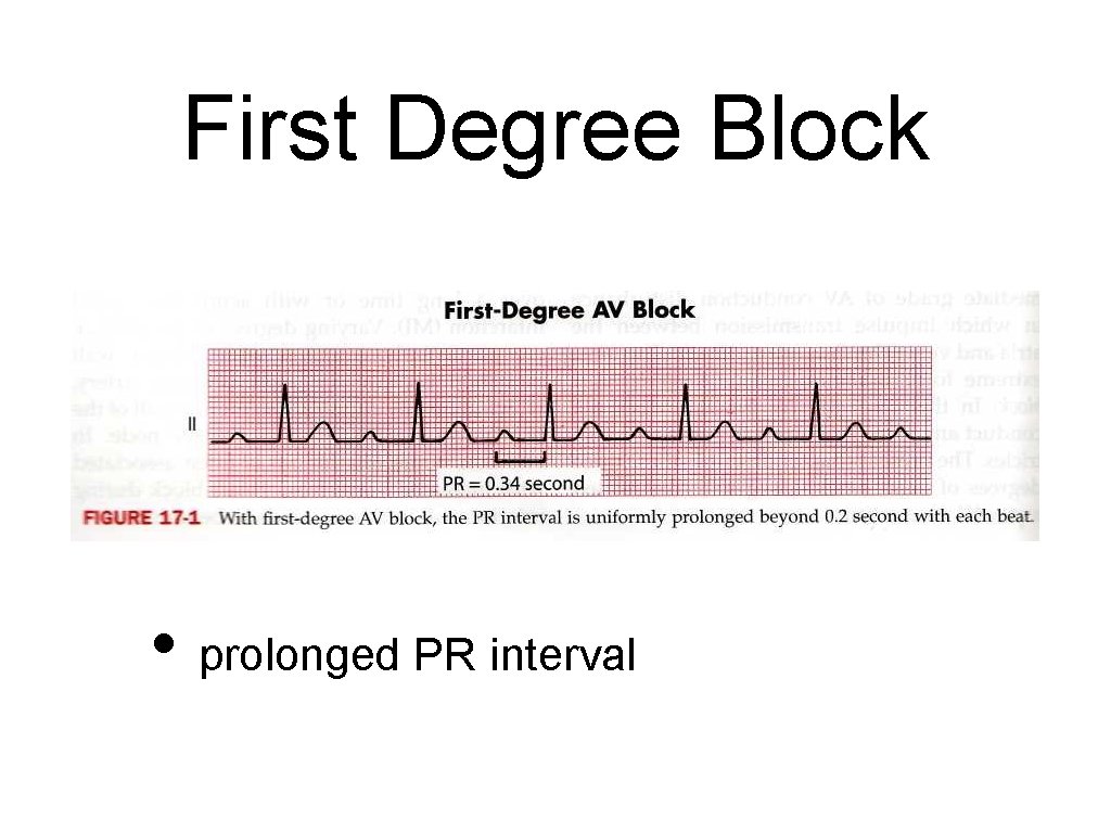 First Degree Block • prolonged PR interval 