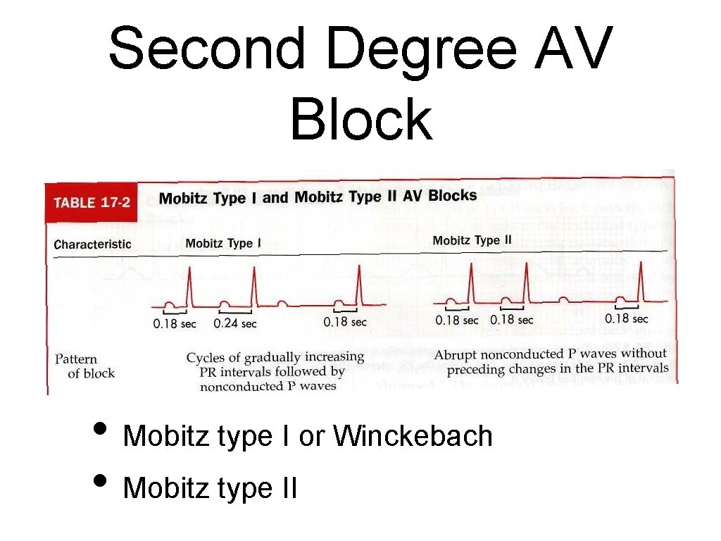 Second Degree AV Block • Mobitz type I or Winckebach • Mobitz type II