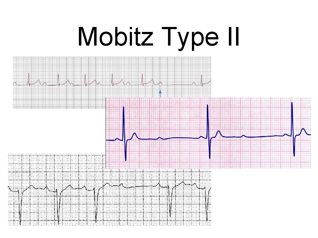 Mobitz Type II 