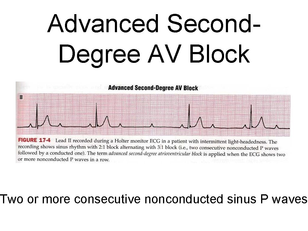 Advanced Second. Degree AV Block Two or more consecutive nonconducted sinus P waves 