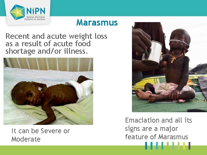 Marasmus Recent and acute weight loss as a result of acute food shortage and/or