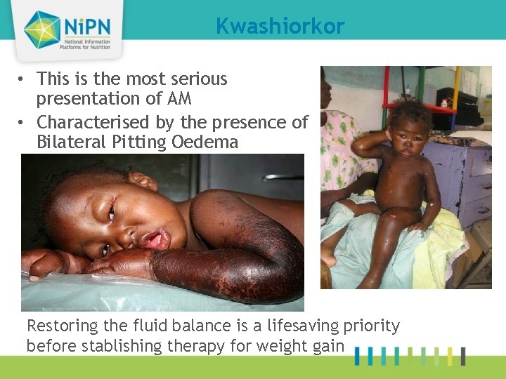 Kwashiorkor • This is the most serious presentation of AM • Characterised by the