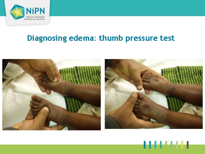 Diagnosing edema: thumb pressure test 15 