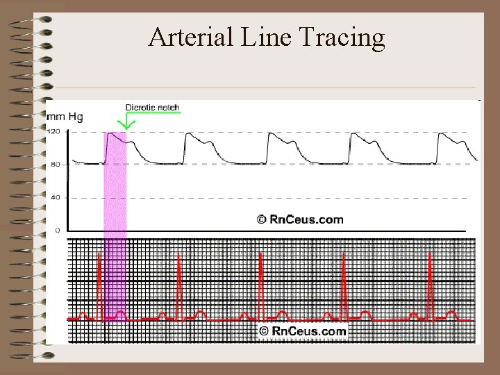 Arterial Line Tracing 