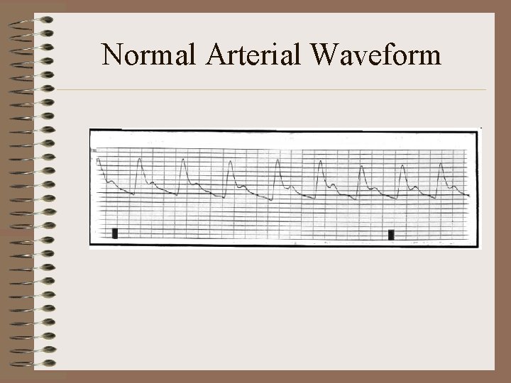Normal Arterial Waveform 