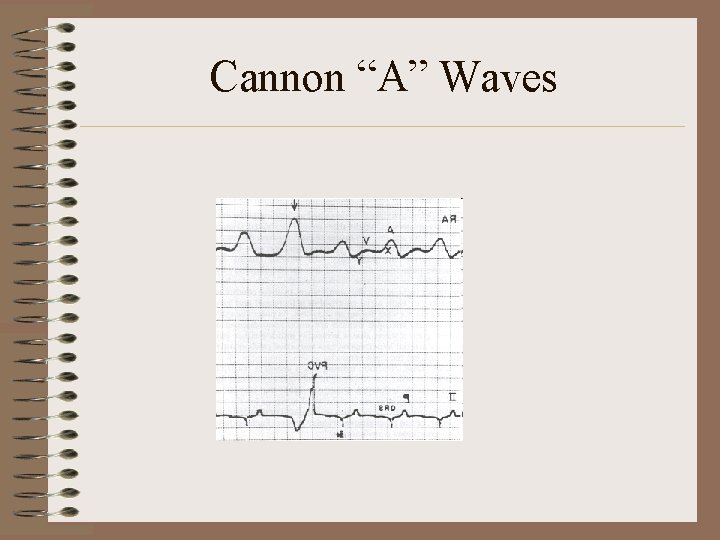 Cannon “A” Waves 