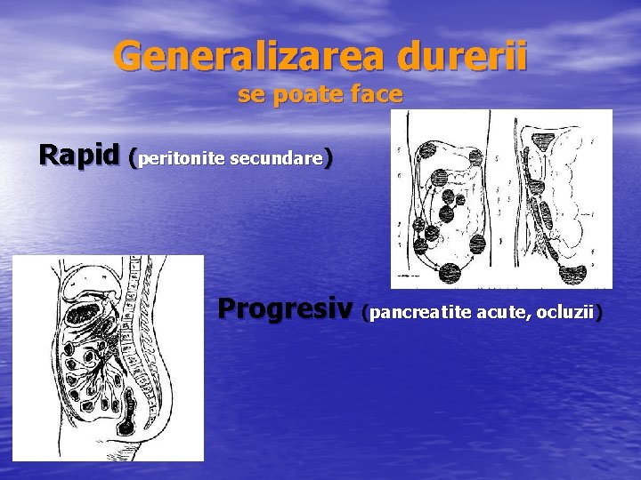 Generalizarea durerii se poate face Rapid (peritonite secundare) Progresiv (pancreatite acute, ocluzii) 