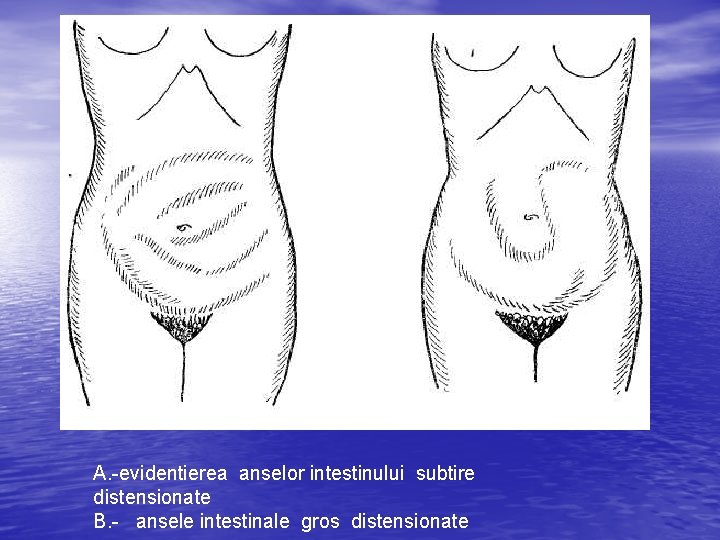 A. -evidentierea anselor intestinului subtire distensionate B. - ansele intestinale gros distensionate 