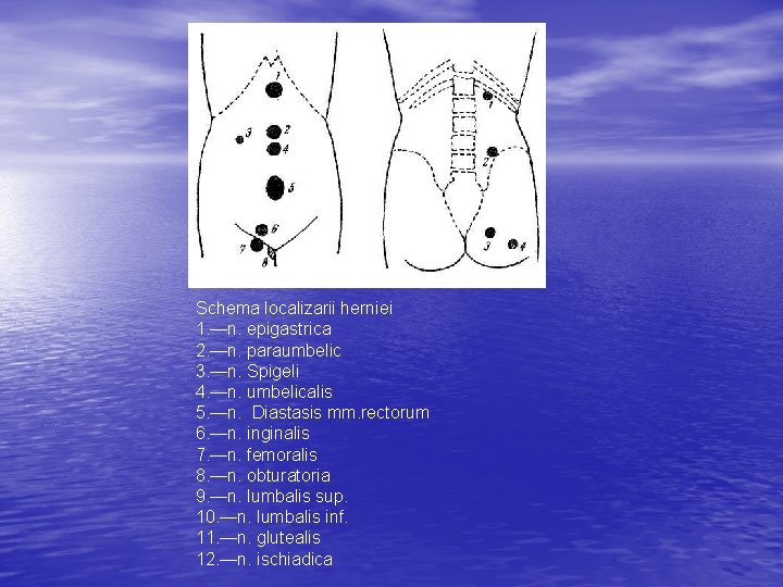 Schema localizarii herniei 1. —n. epigastrica 2. —n. paraumbelic 3. —n. Spigeli 4. —n.