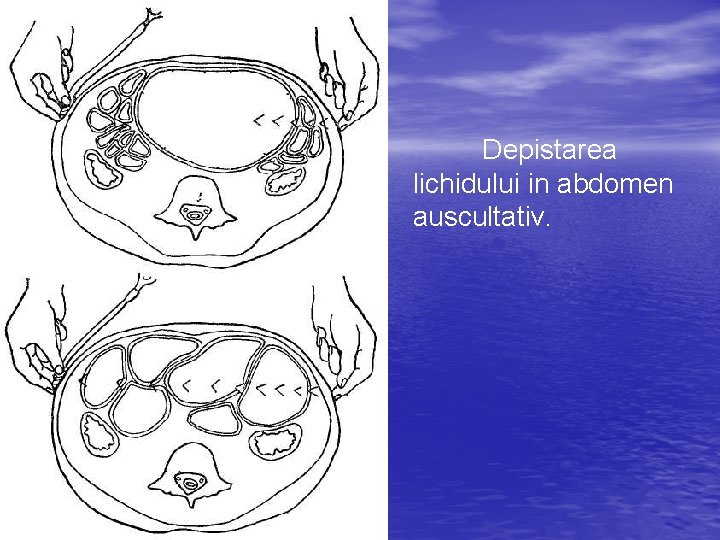 Depistarea lichidului in abdomen auscultativ. 