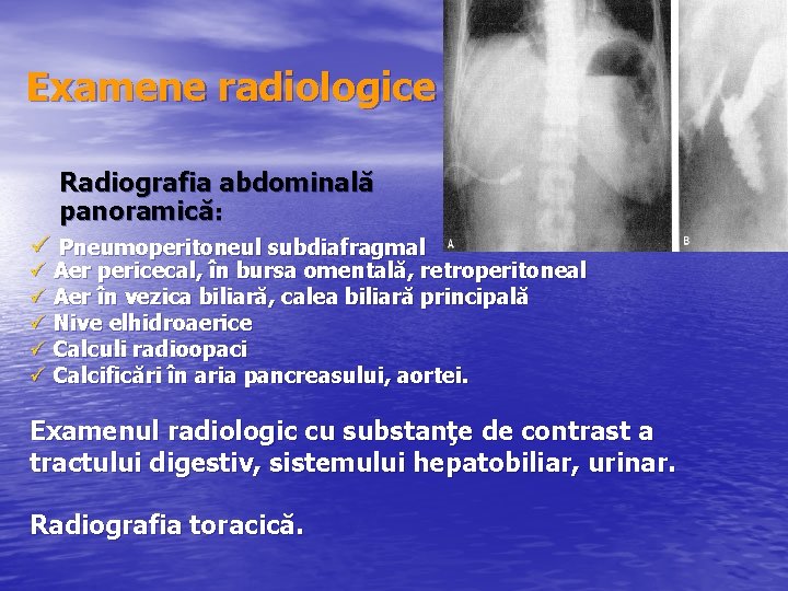 Examene radiologice Radiografia abdominală panoramică: ü Pneumoperitoneul subdiafragmal ü Aer pericecal, în bursa omentală,