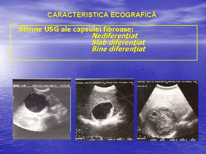 CARACTERISTICA ECOGRAFICĂ Semne USG ale capsulei fibroase: Nediferenţiat Slab diferenţiat Bine diferenţiat 