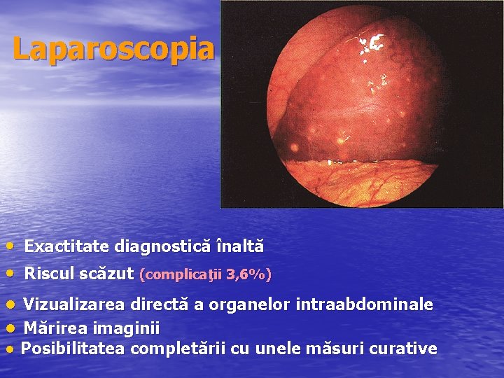 Laparoscopia • Exactitate diagnostică înaltă • Riscul scăzut (complicaţii 3, 6%) ● Vizualizarea directă