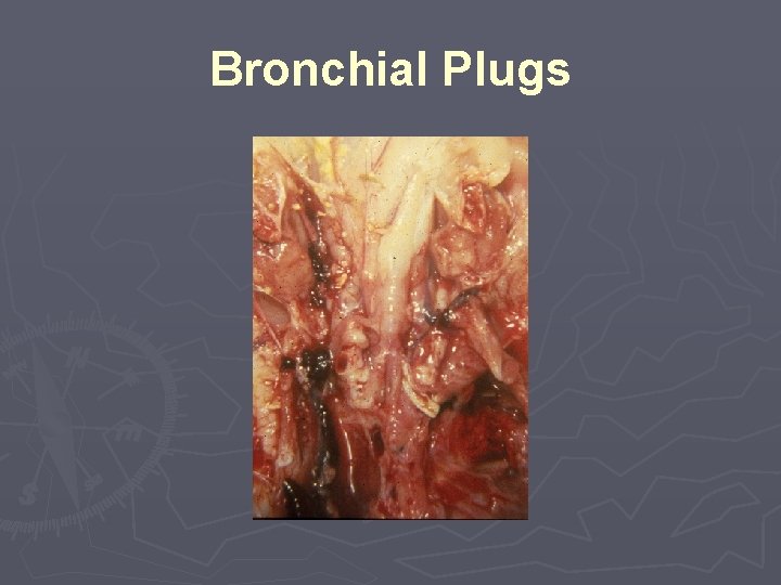 Bronchial Plugs 