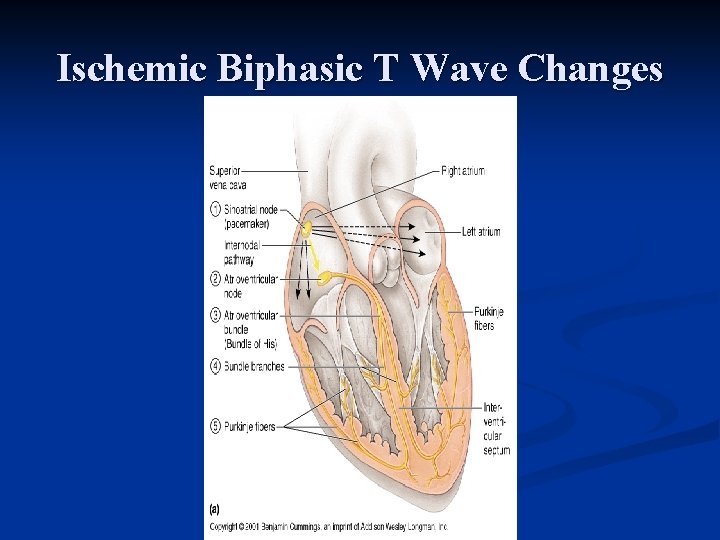 Ischemic Biphasic T Wave Changes 