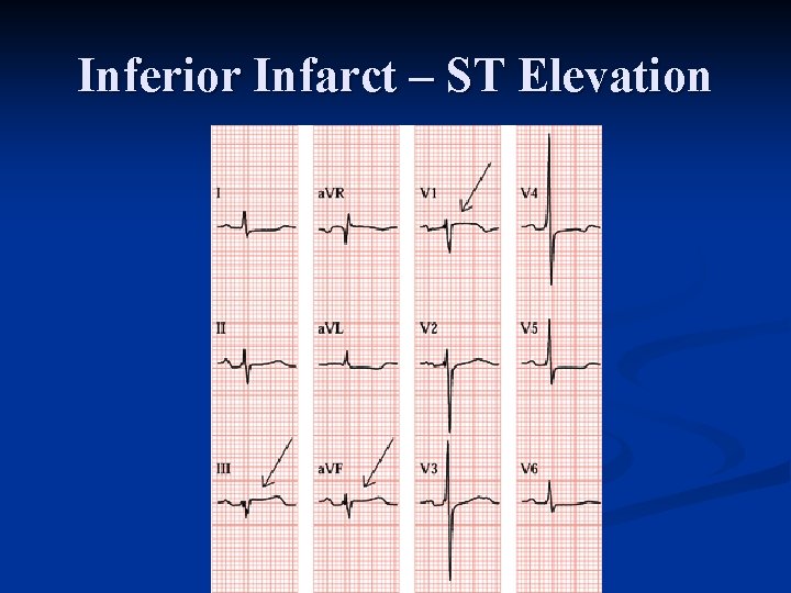 Inferior Infarct – ST Elevation 