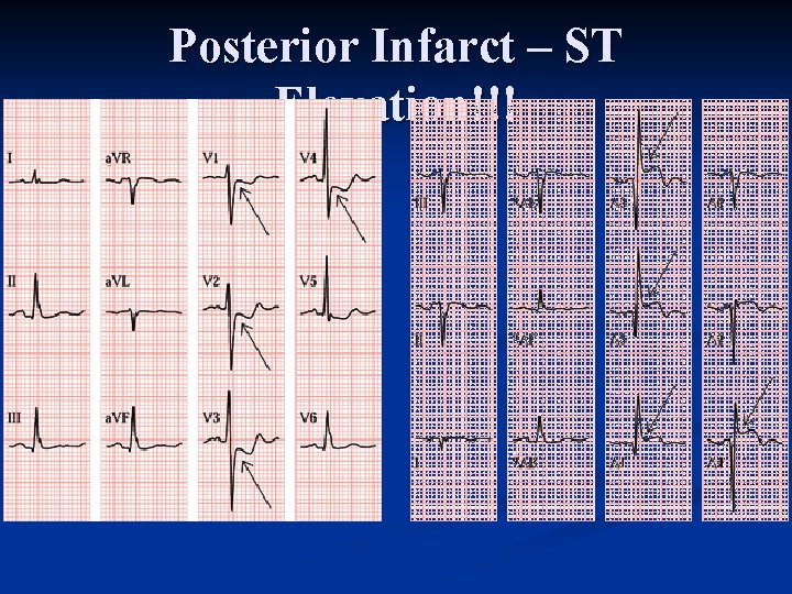 Posterior Infarct – ST Elevation!!! 