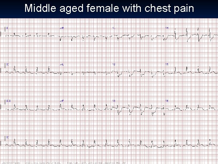 Middle aged female with chest pain 