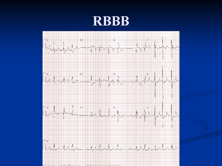 RBBB 