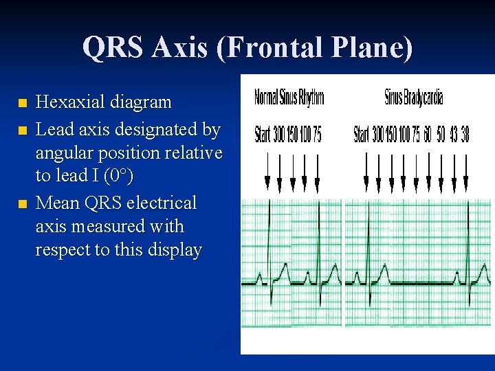 QRS Axis (Frontal Plane) n n n Hexaxial diagram Lead axis designated by angular