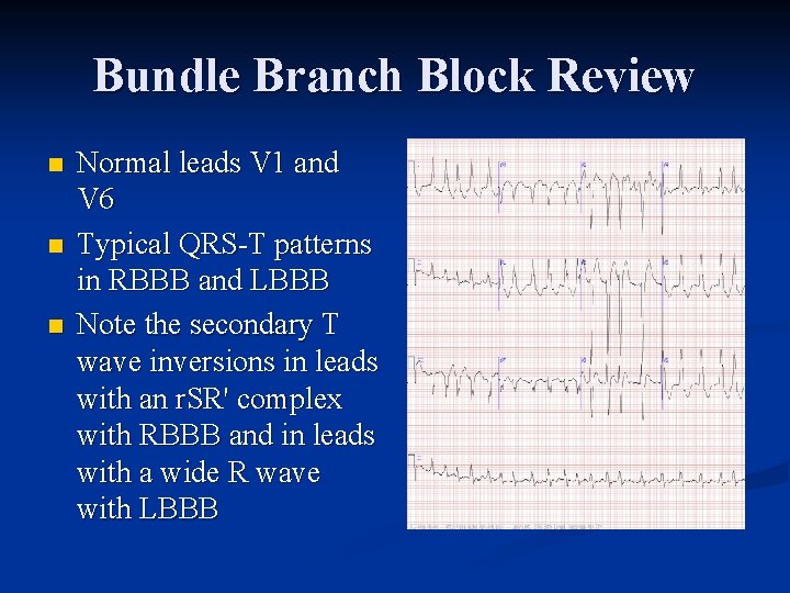 Bundle Branch Block Review n n n Normal leads V 1 and V 6