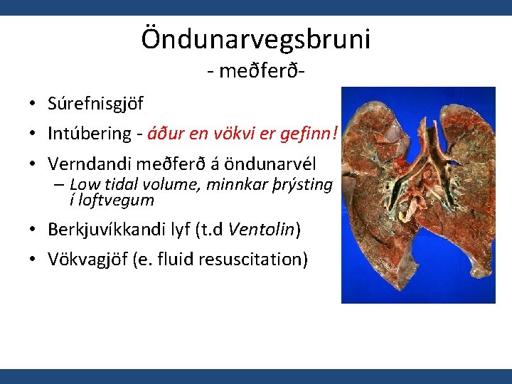 Öndunarvegsbruni - meðferð- • Súrefnisgjöf • Intúbering - áður en vökvi er gefinn! •