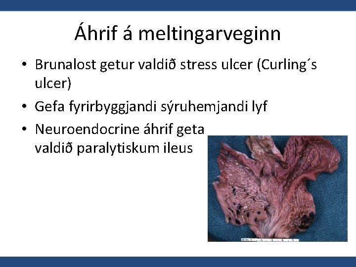 Áhrif á meltingarveginn • Brunalost getur valdið stress ulcer (Curling´s ulcer) • Gefa fyrirbyggjandi