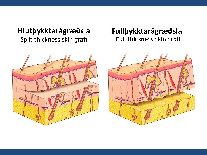 Hlutþykktarágræðsla Split thickness skin graft Fullþykktarágræðsla Full thickness skin graft 