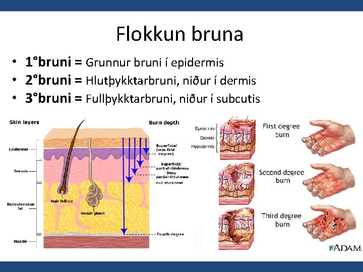 Flokkun bruna • 1°bruni = Grunnur bruni í epidermis • 2°bruni = Hlutþykktarbruni, niður