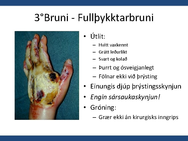 3°Bruni - Fullþykktarbruni • Útlit: – Hvítt vaxkennt – Grátt leðurlíkt – Svart og