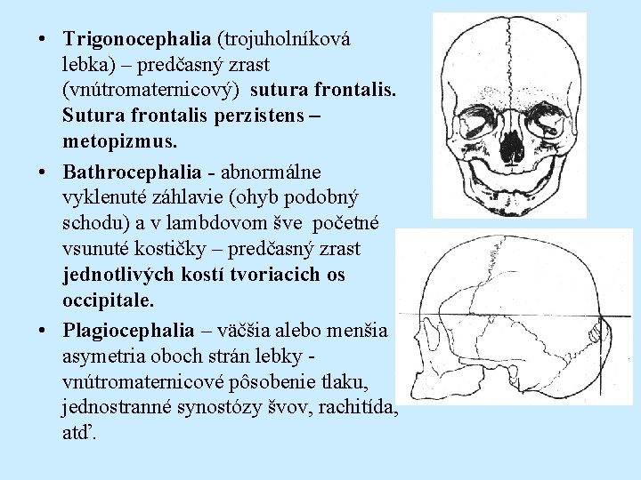  • Trigonocephalia (trojuholníková lebka) – predčasný zrast (vnútromaternicový) sutura frontalis. Sutura frontalis perzistens