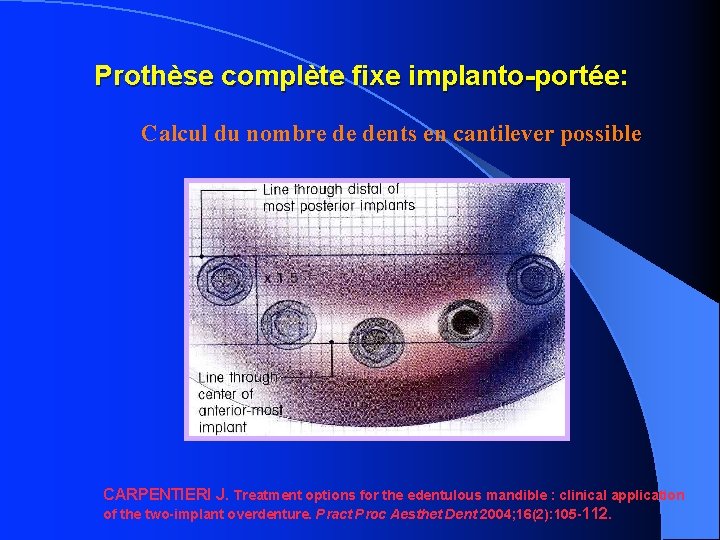 Prothèse complète fixe implanto-portée: Calcul du nombre de dents en cantilever possible CARPENTIERI J.