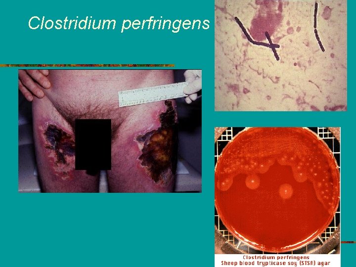Clostridium perfringens 