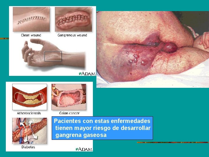 Pacientes con estas enfermedades tienen mayor riesgo de desarrollar gangrena gaseosa 