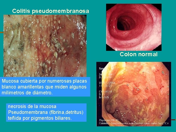 Colitis pseudomembranosa Colon normal Mucosa cubierta por numerosas placas blanco amarillentas que miden algunos