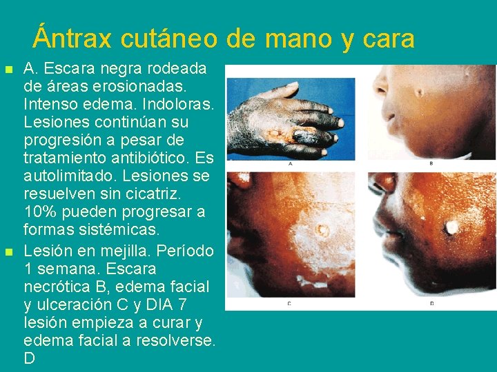 Ántrax cutáneo de mano y cara n n A. Escara negra rodeada de áreas