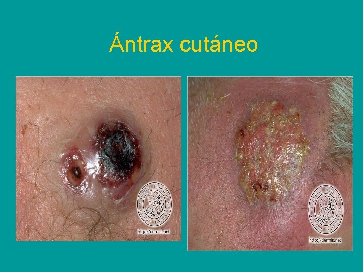 Ántrax cutáneo 