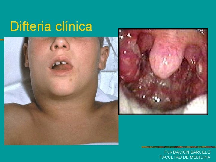 Difteria clínica FUNDACION BARCELO FACULTAD DE MEDICINA 