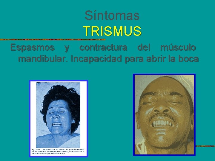 Síntomas TRISMUS Espasmos y contractura del músculo mandibular. Incapacidad para abrir la boca 