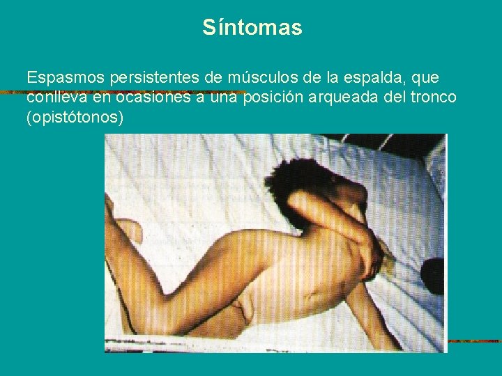 Síntomas Espasmos persistentes de músculos de la espalda, que conlleva en ocasiones a una