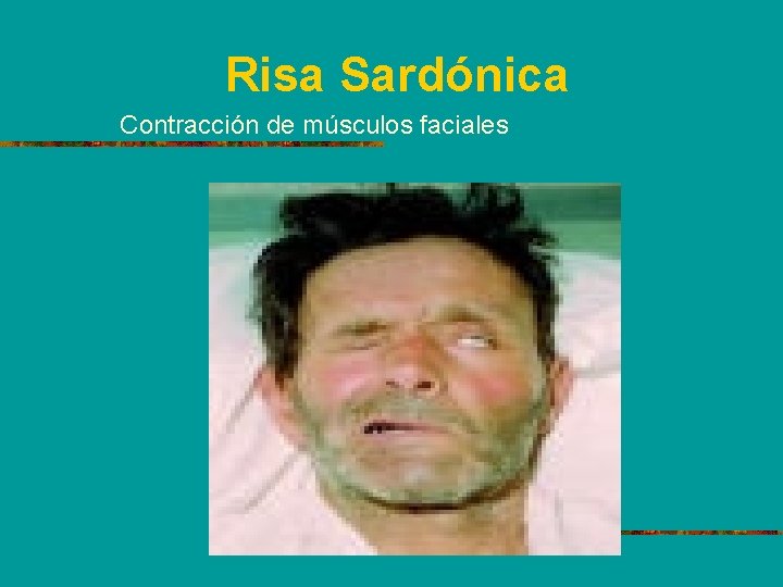Risa Sardónica Contracción de músculos faciales 