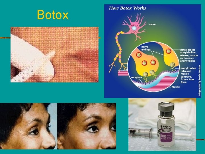 Botox 