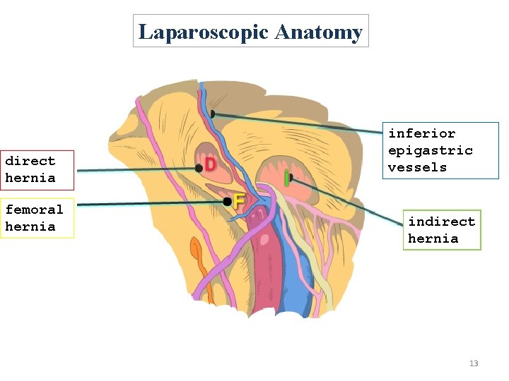 Laparoscopic Anatomy direct hernia femoral hernia inferior epigastric vessels indirect hernia 13 