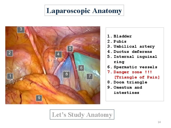 Laparoscopic Anatomy 1. Bladder 2. Pubis 3. Umbilical artery 4. Ductus deferens 5. Internal