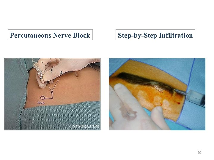 Percutaneous Nerve Block Step-by-Step Infiltration 20 
