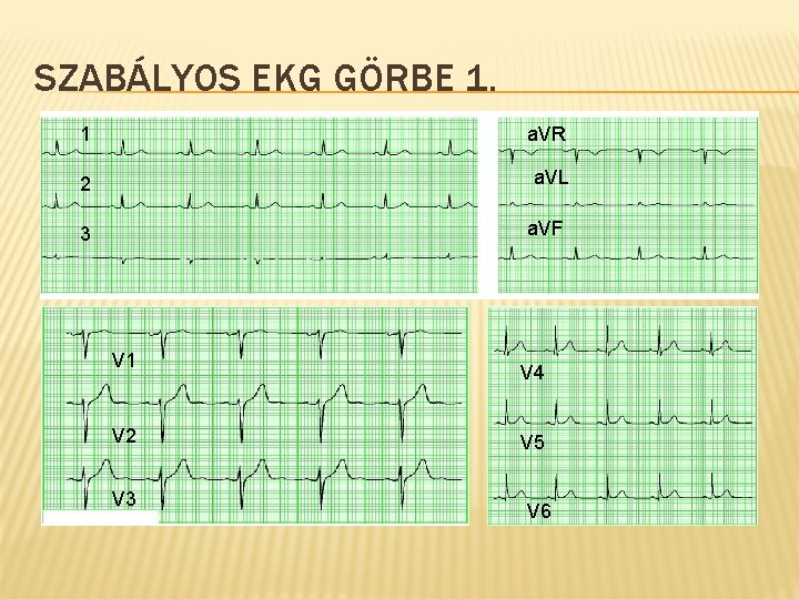 SZABÁLYOS EKG GÖRBE 1. 1 a. VR 2 a. VL 3 a. VF V
