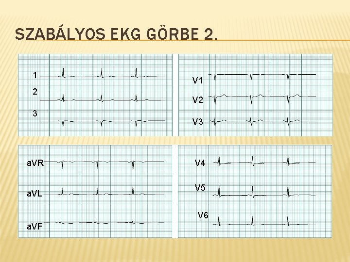 SZABÁLYOS EKG GÖRBE 2. 1 2 3 a. VR a. VL V 1 V