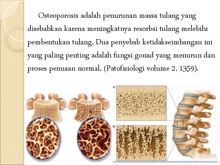 Osteoporosis adalah penurunan massa tulang yang disebabkan karena meningkatnya resorbsi tulang melebihi pembentukan tulang.