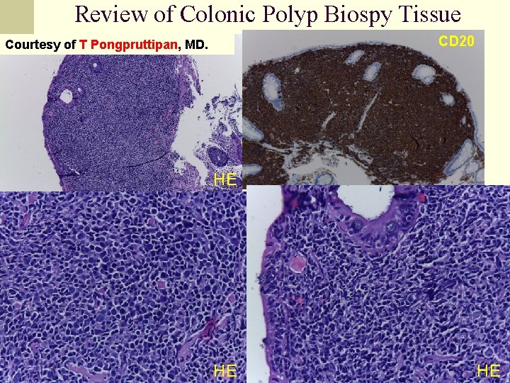 Review of Colonic Polyp Biospy Tissue CD 20 Courtesy of T Pongpruttipan, MD. HE